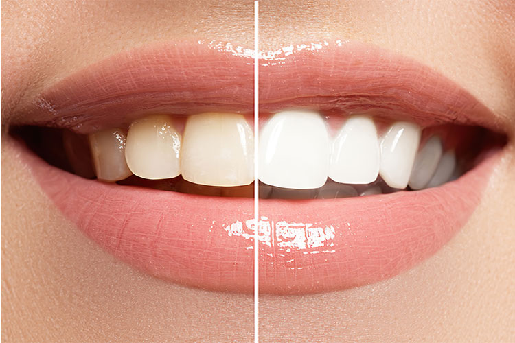 Clareamento dental